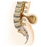 脊髓脊膜突出